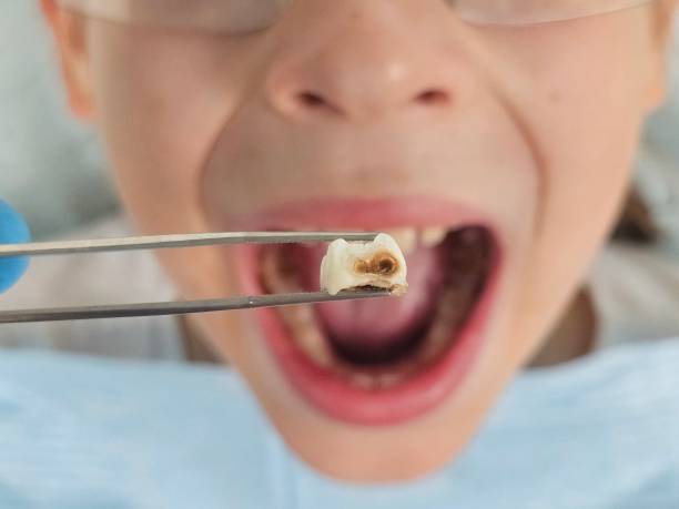 Best Emergency Dental Extractions in Orchard Mesa, CO